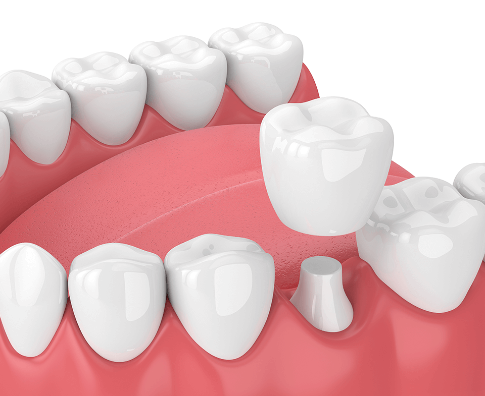 illustration of a dental crown