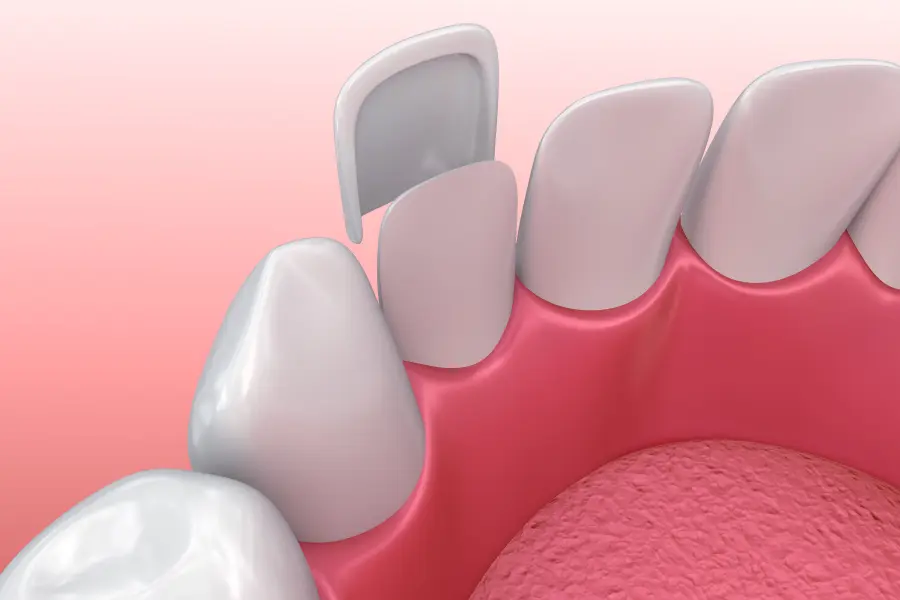 digital illustration of a dental veneer being placed over a tooth
