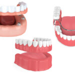 Illustrations of full, partial, and implant-supported dentures