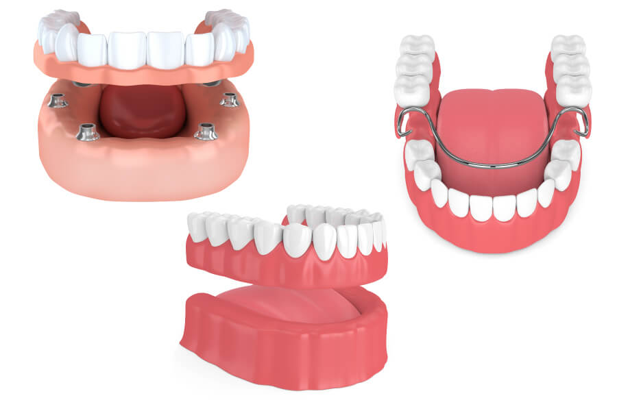 Illustrations of full, partial, and implant-supported dentures