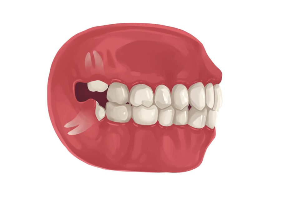 Illustration of a mouth with erupting wisdom teeth that could be removed at Bellevue Dental Oasis