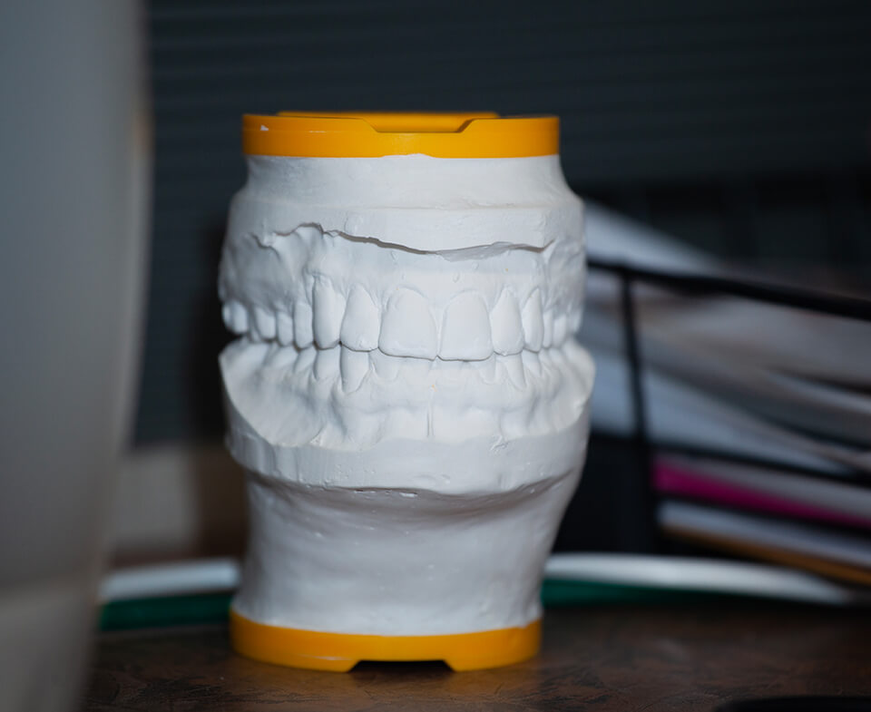 plaster model of teeth