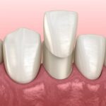 graphic image of dental veneers