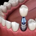 how long does a dental implant last