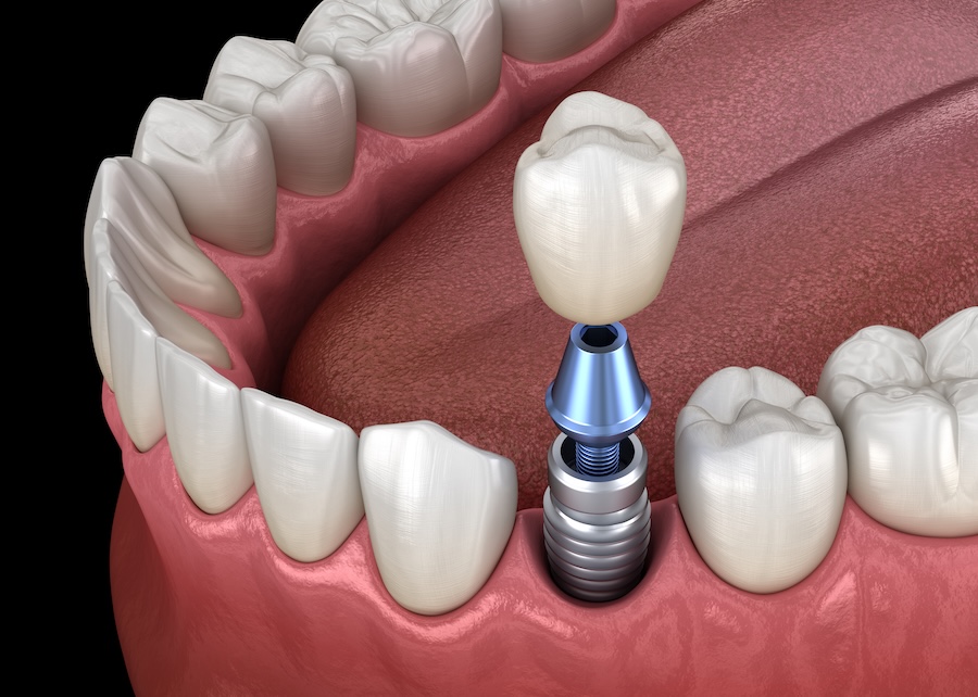how long does a dental implant last