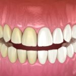 professional teeth whitening