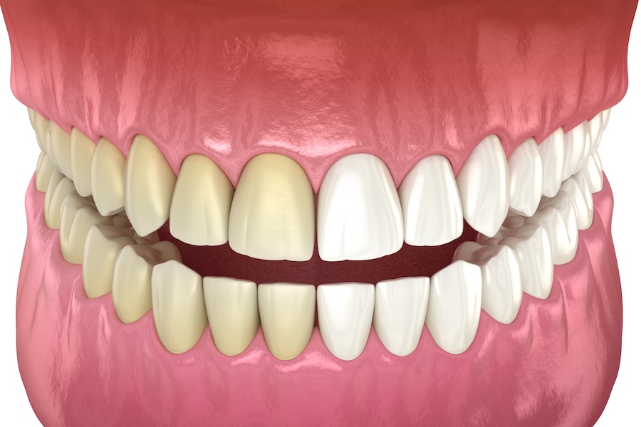 professional teeth whitening